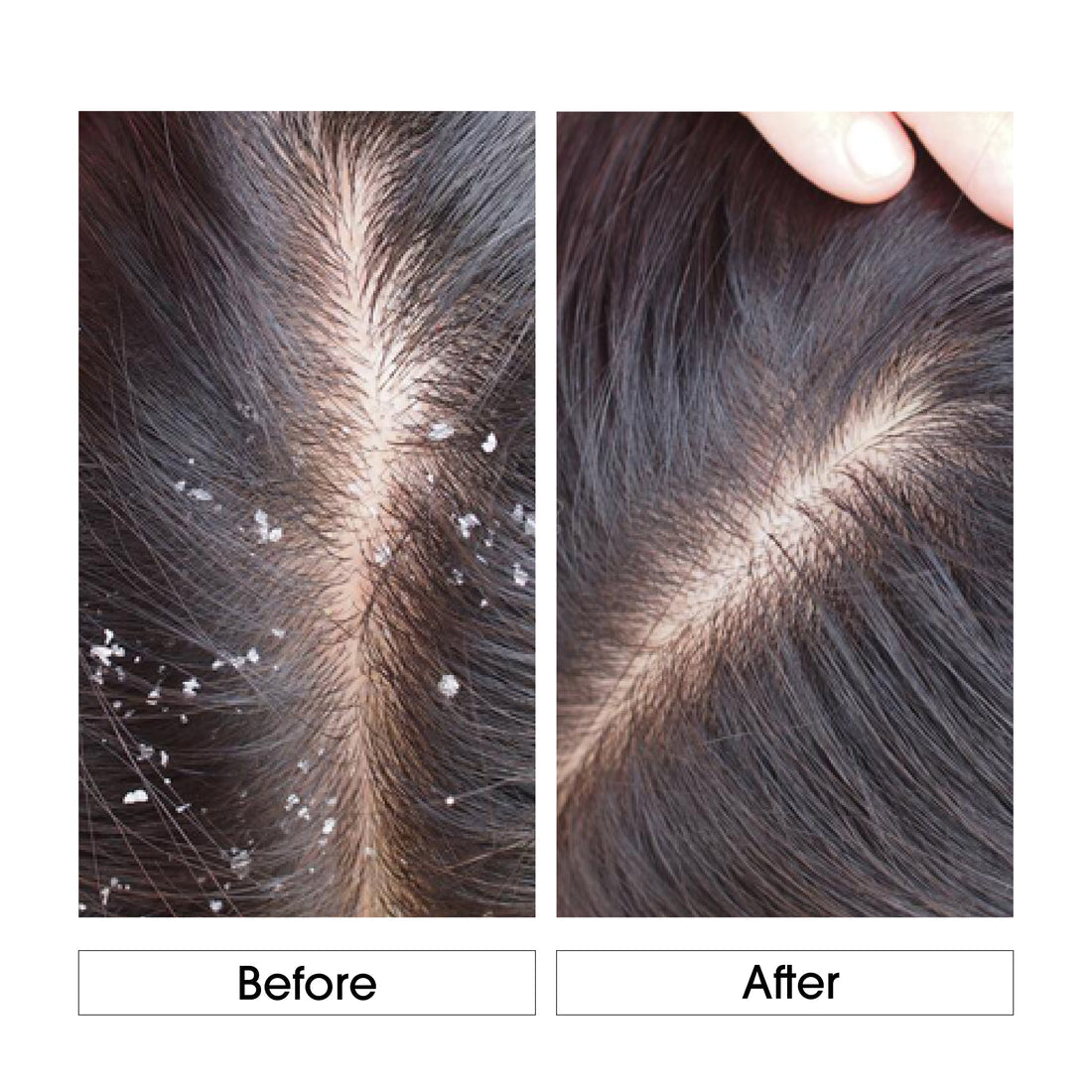Niconi Anti-Dandruff Shampoo For Men And Women BUY 1 GET 1 FREE
